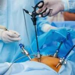 胃バイパス術および右半結腸切除術 における腹腔鏡アノテーション
